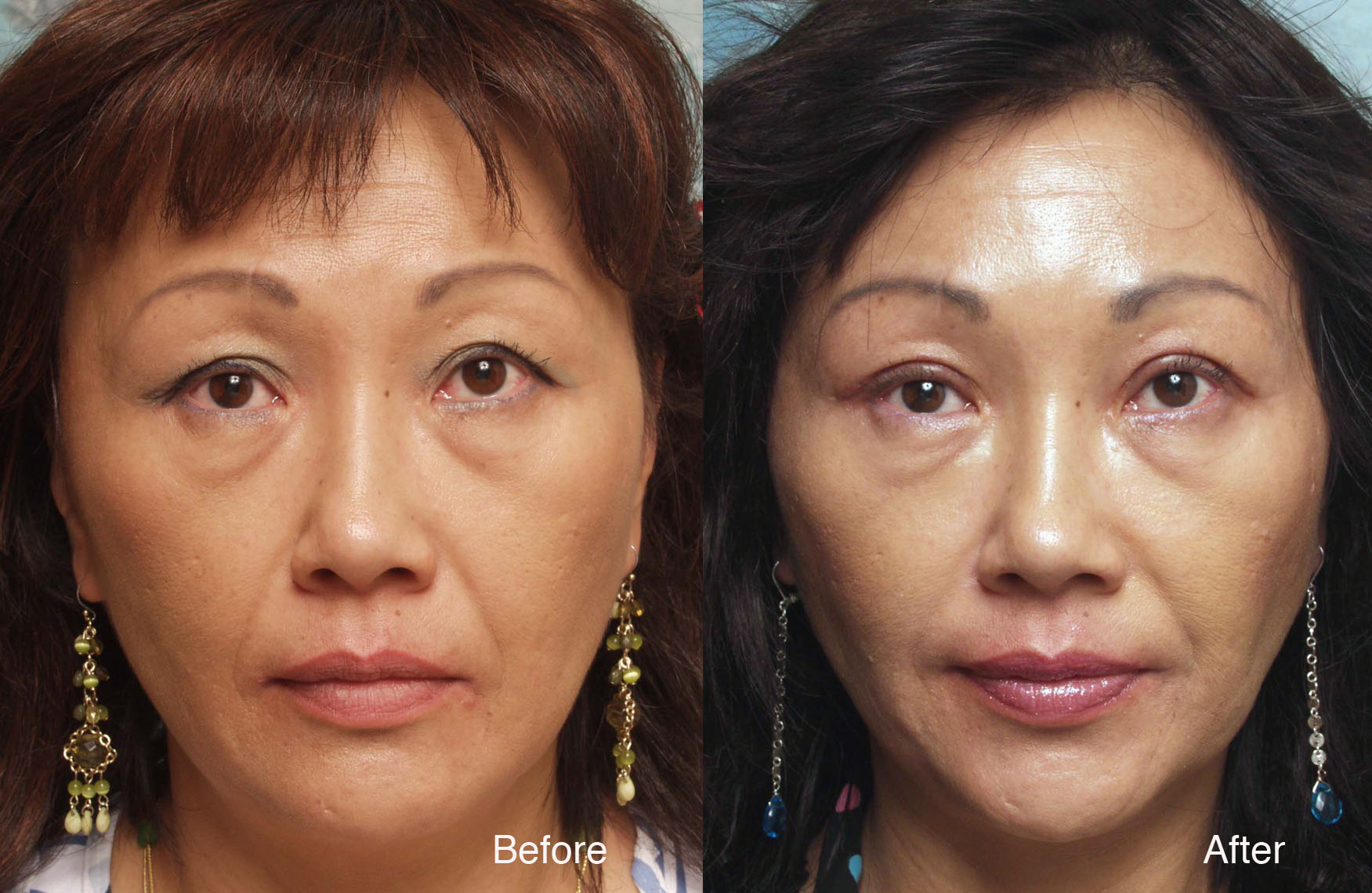 beverly hills asian eyelid surgery