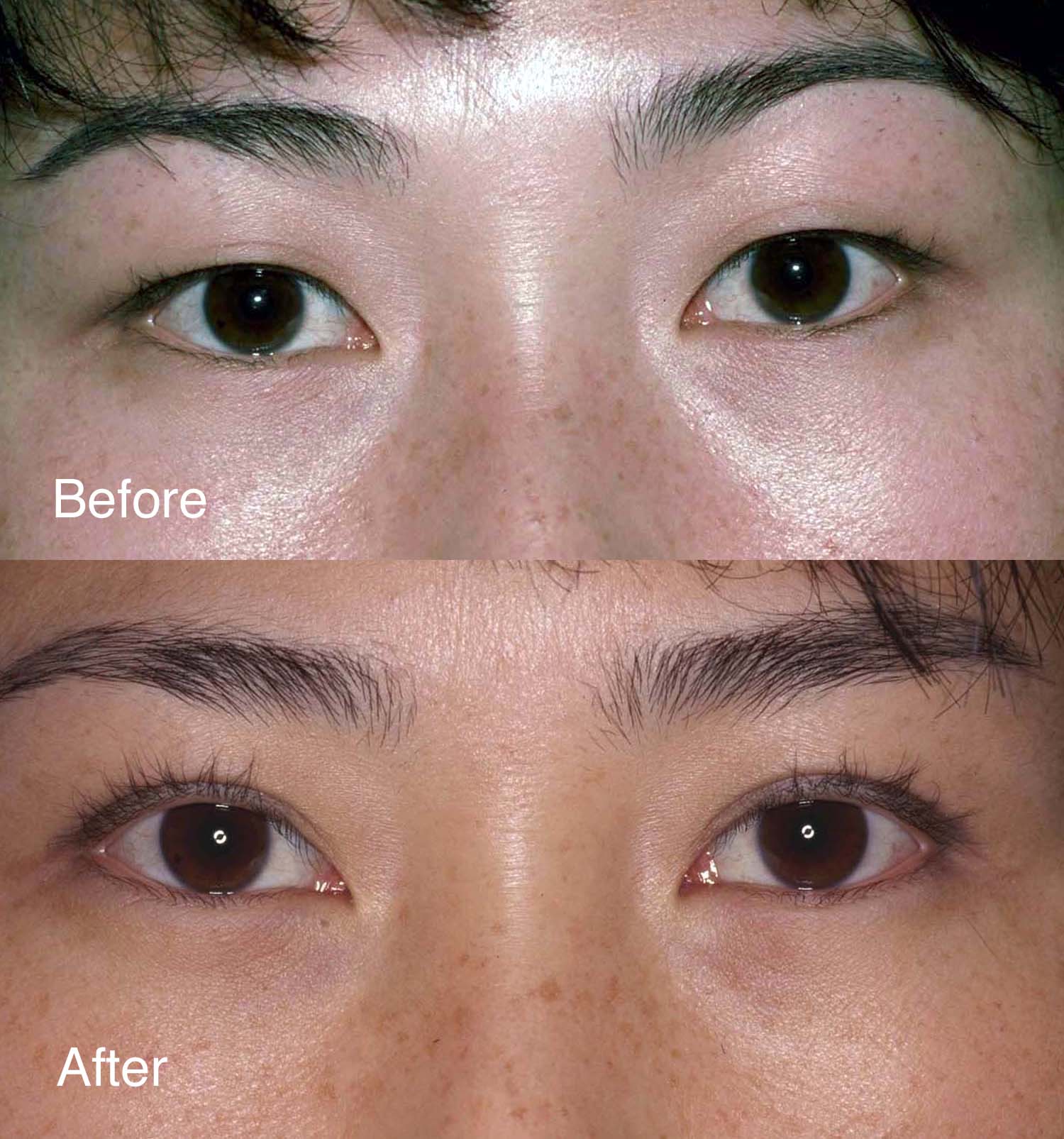 beverly hills asian eyelid surgery