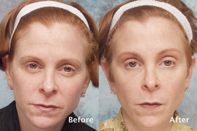 Botox example