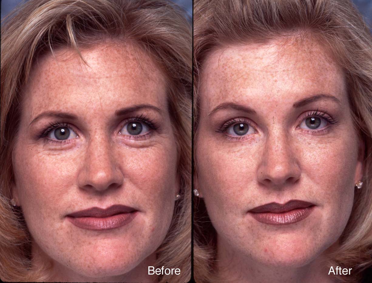 Botox-example-2-L