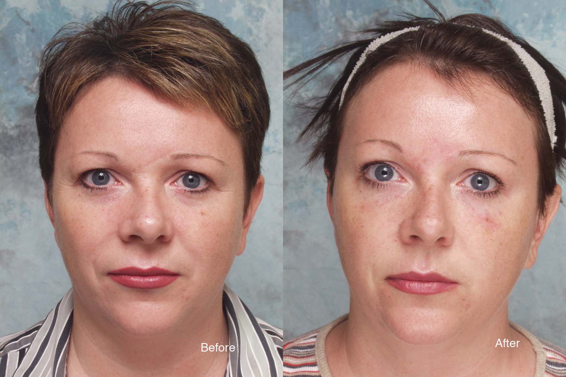 Botox Case Studies Beverly Hills | Dysport Beverly Hills ...