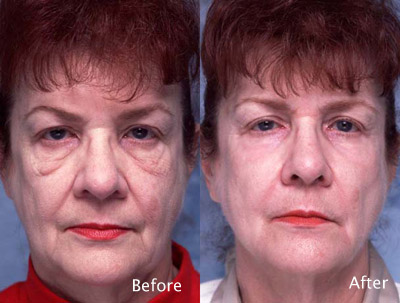 Chemical Peel Example Chemical-Peel-Example-1