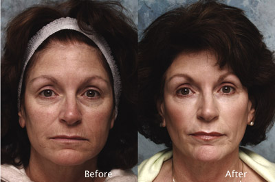 Chemical-Peel-Example-2