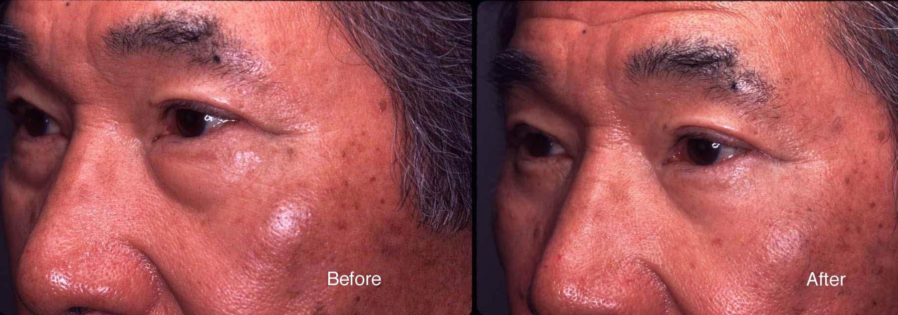 Chemical-peel-example-3-L