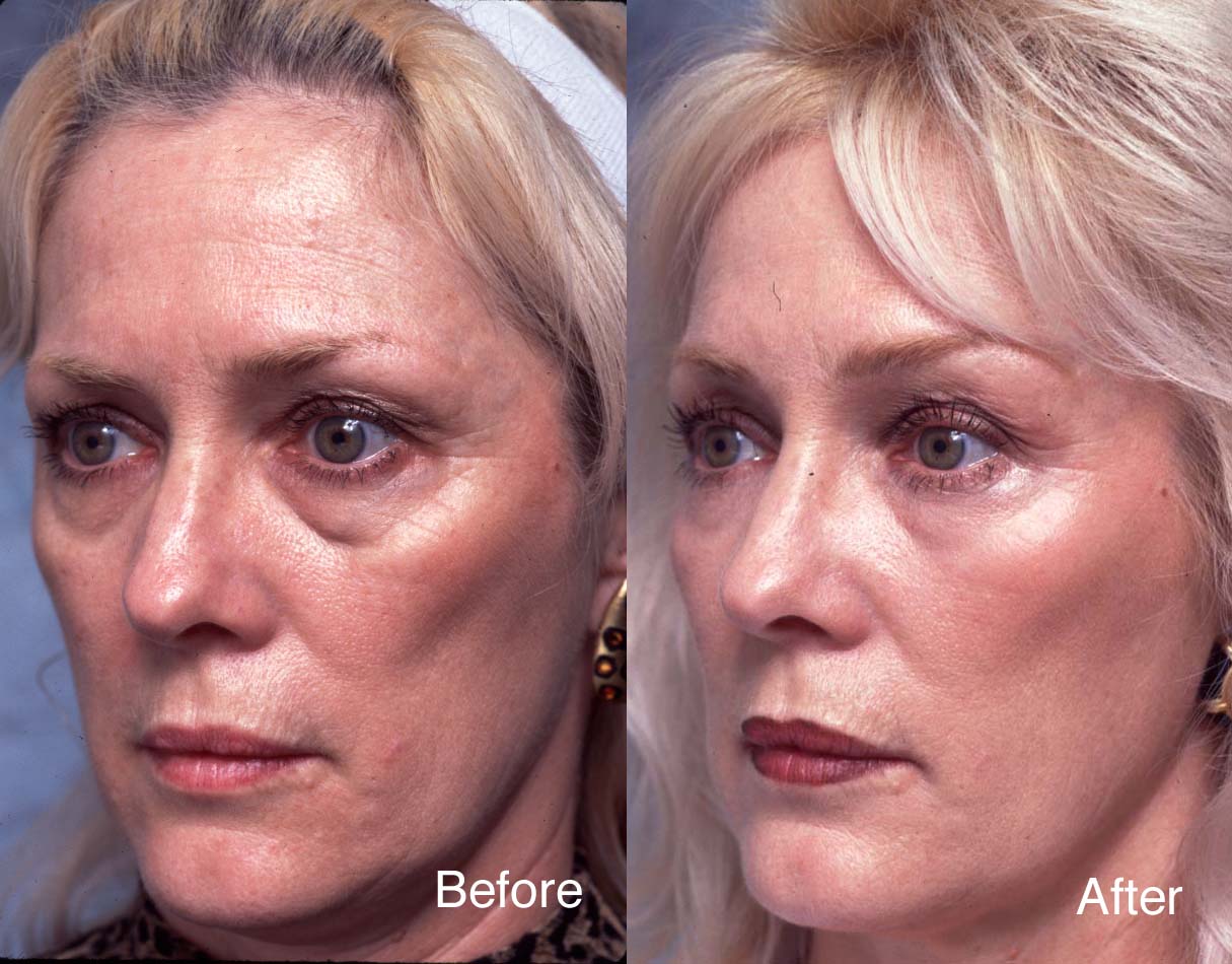 Does Retin A Remove Wrinkles Clearance xn--h1aahyg1df.xn--p1ai