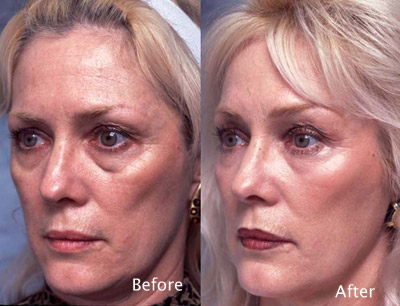 Chemical-peel-example-5