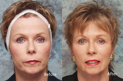 Chemical-peel-example-6