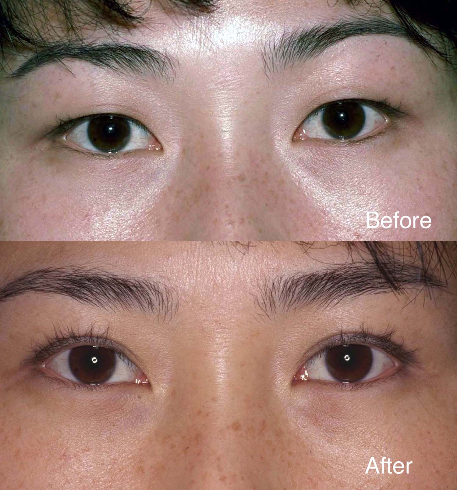 Eyelid Ptosis Surgery Los Angeles