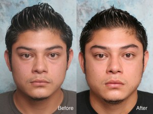 Eyelid surgery example