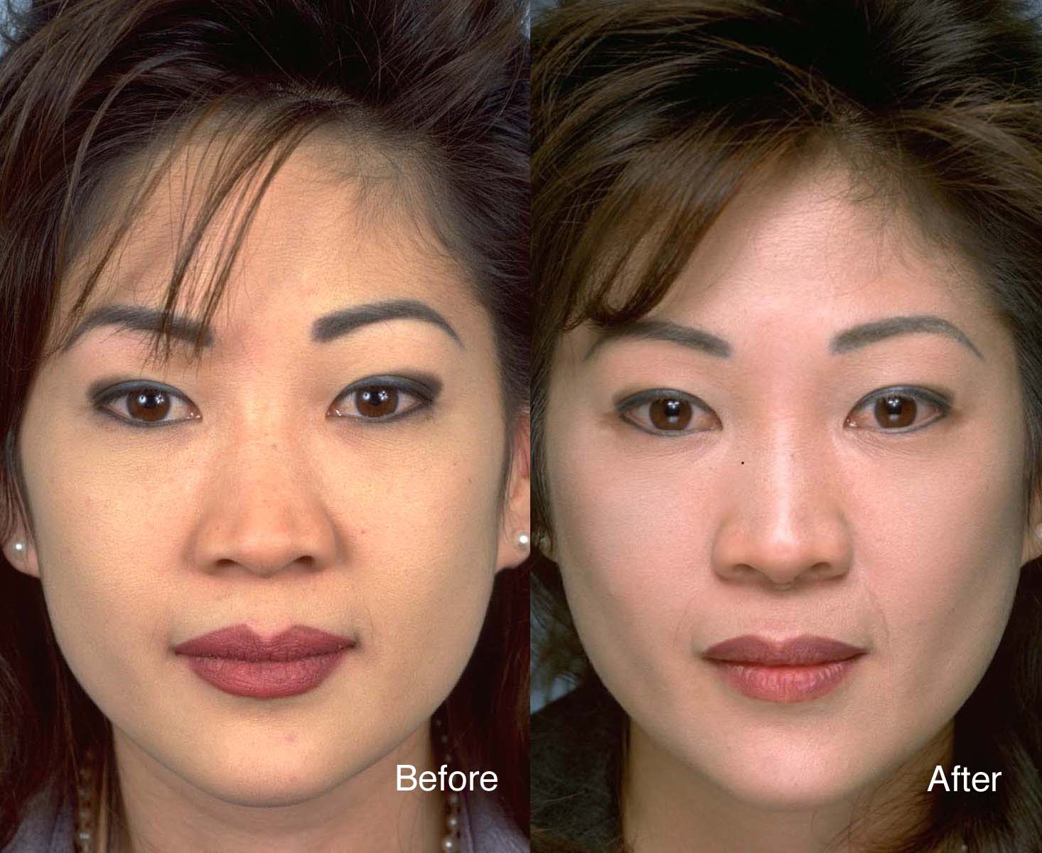 Facial-surgery-example-2-L