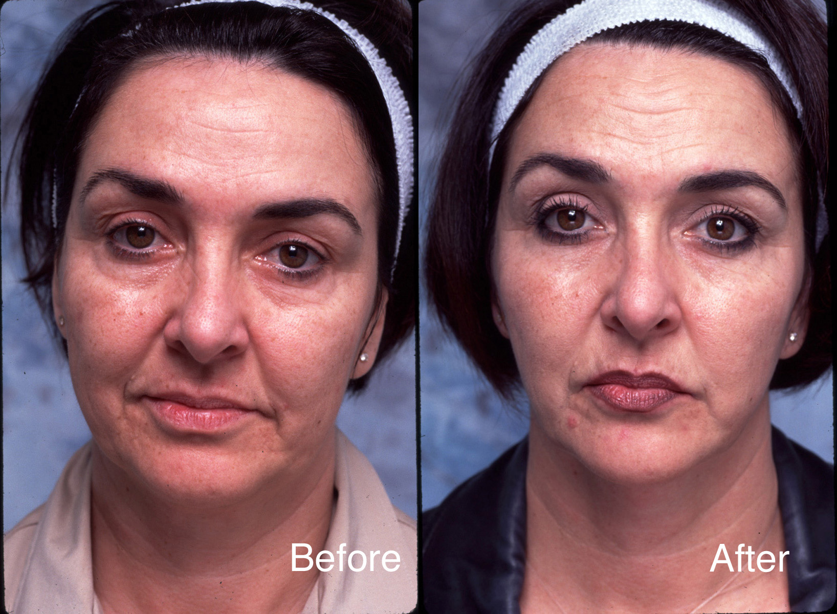 Facial-surgery-example-3-L