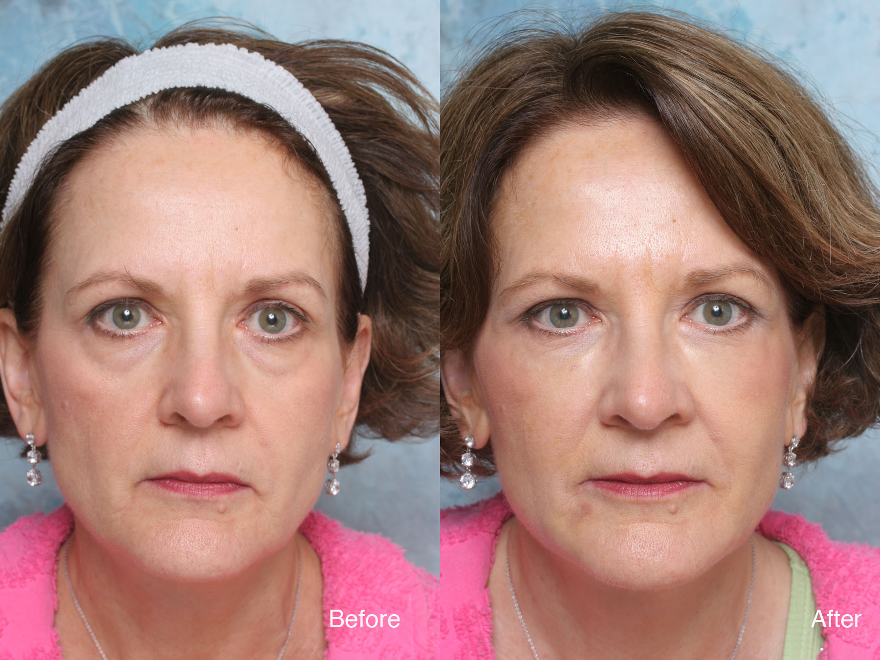 Restylane Under Eye Filler Before And After - All You Need Infos