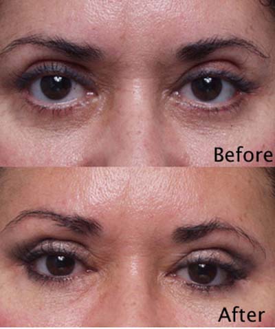  Fixing Eyelid Surgery, Blepharoplasty Revision