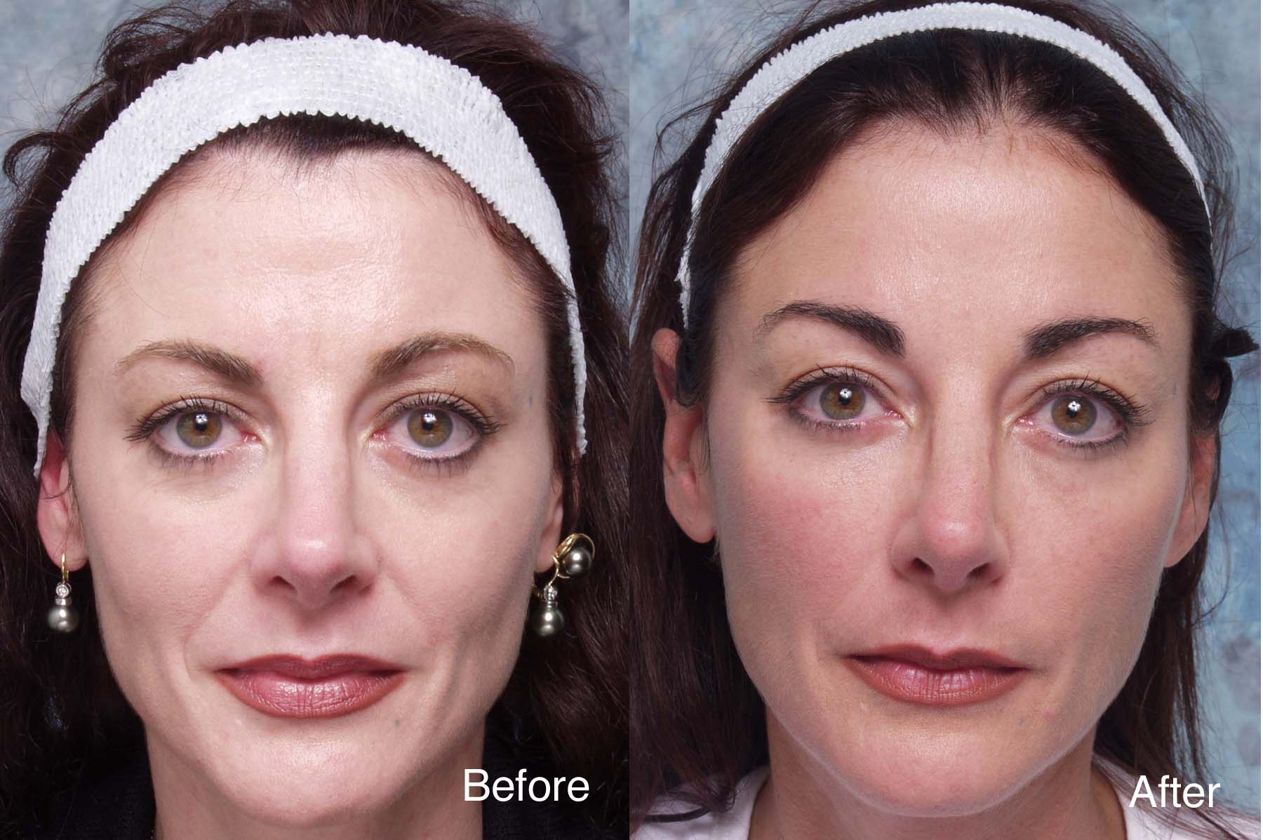 Midface Surgery Case Studies Beverly Hills | Cheek Lift Cases Los Angeles