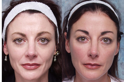 Midface example