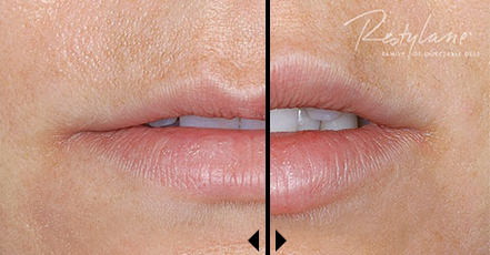 Restylane Cost before and after photos