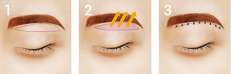 Sub-brow blepharoplasty Beverly Hills Los Angeles Korea Plastic Surgery