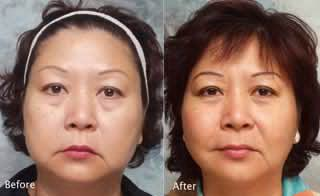 Beverly Hills asian eyelid surgery