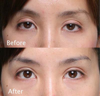 beverly hills asian eyelid surgery