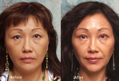 beverly hills asian eyelid surgery