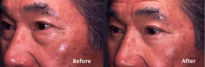 beverly hills asian eyelid surgery