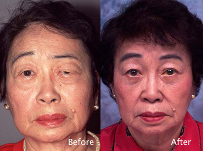 bevery hills asian eyelid surgery