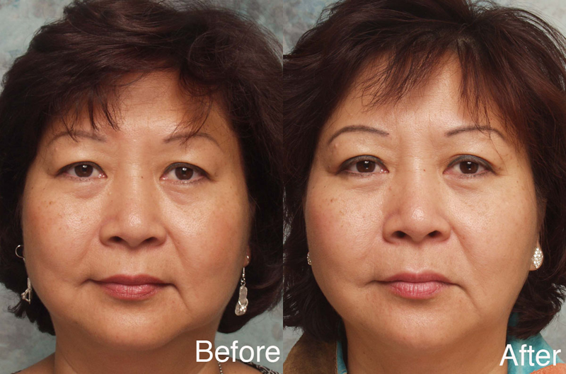 Beverly Hills asian eyelid surgery