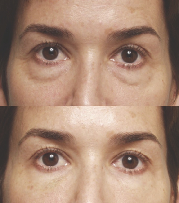 Undereye Filler Before and After  POPSUGAR Beauty