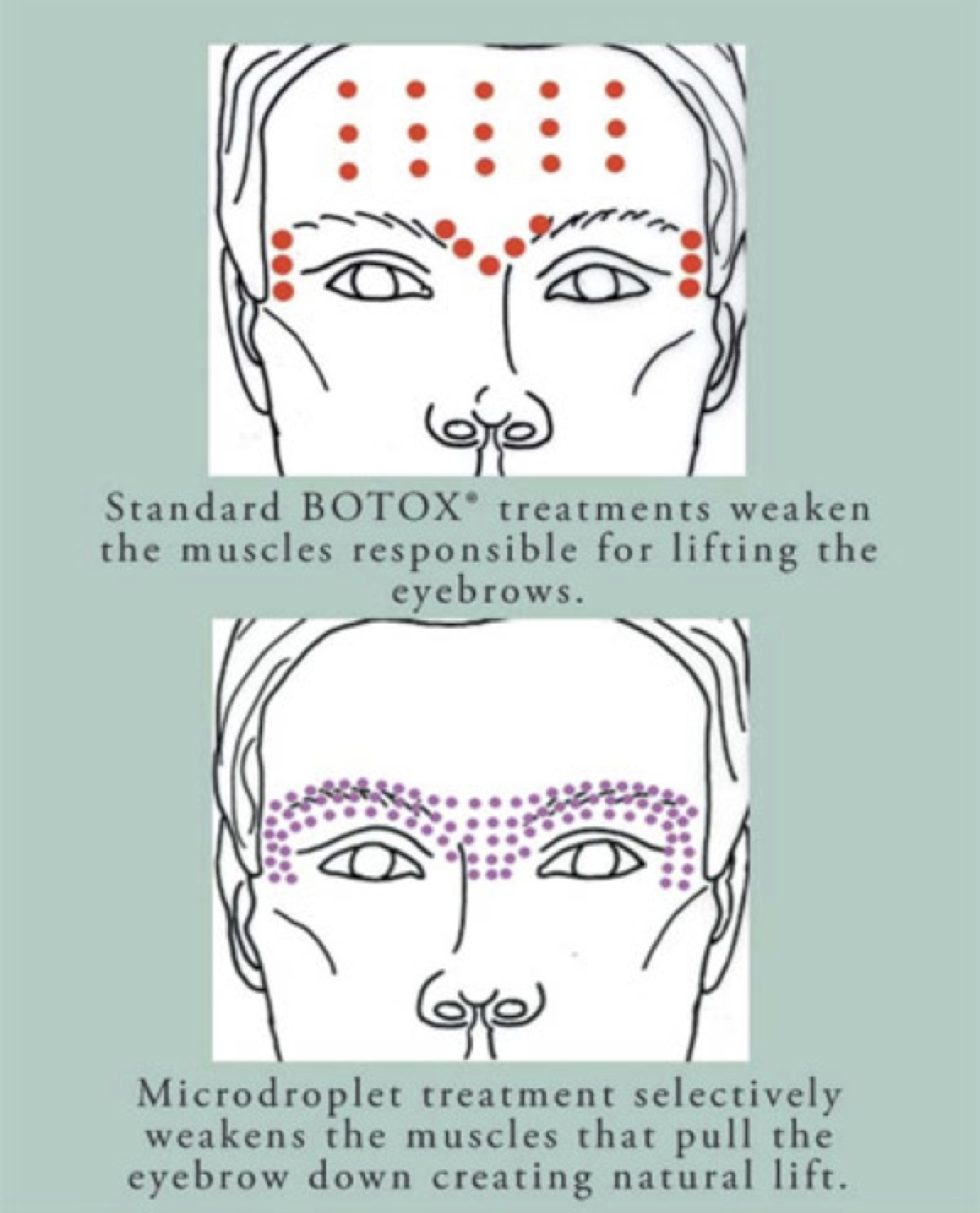 brow lift botox