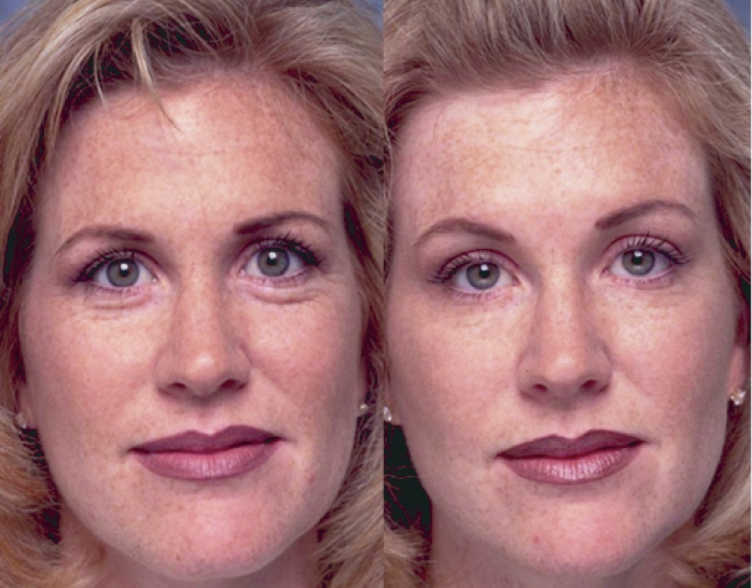 botox brow lift