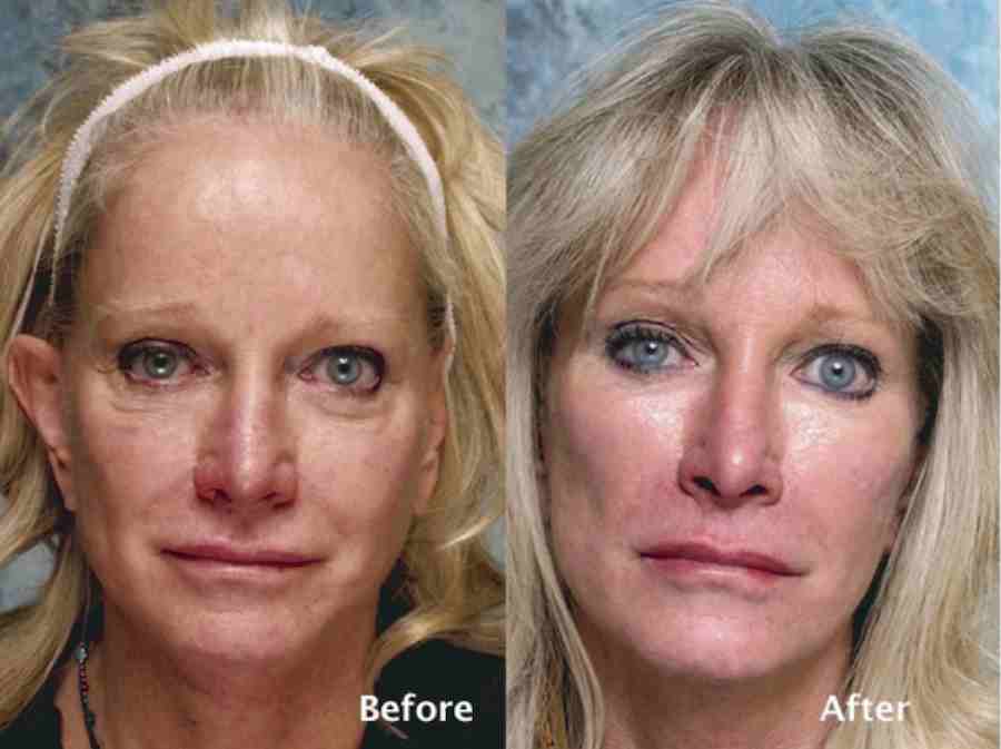 Eyelid Surgery Beverly Hills