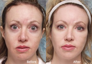 canthoplasty before lateral lift bilateral treatment lidlift midface