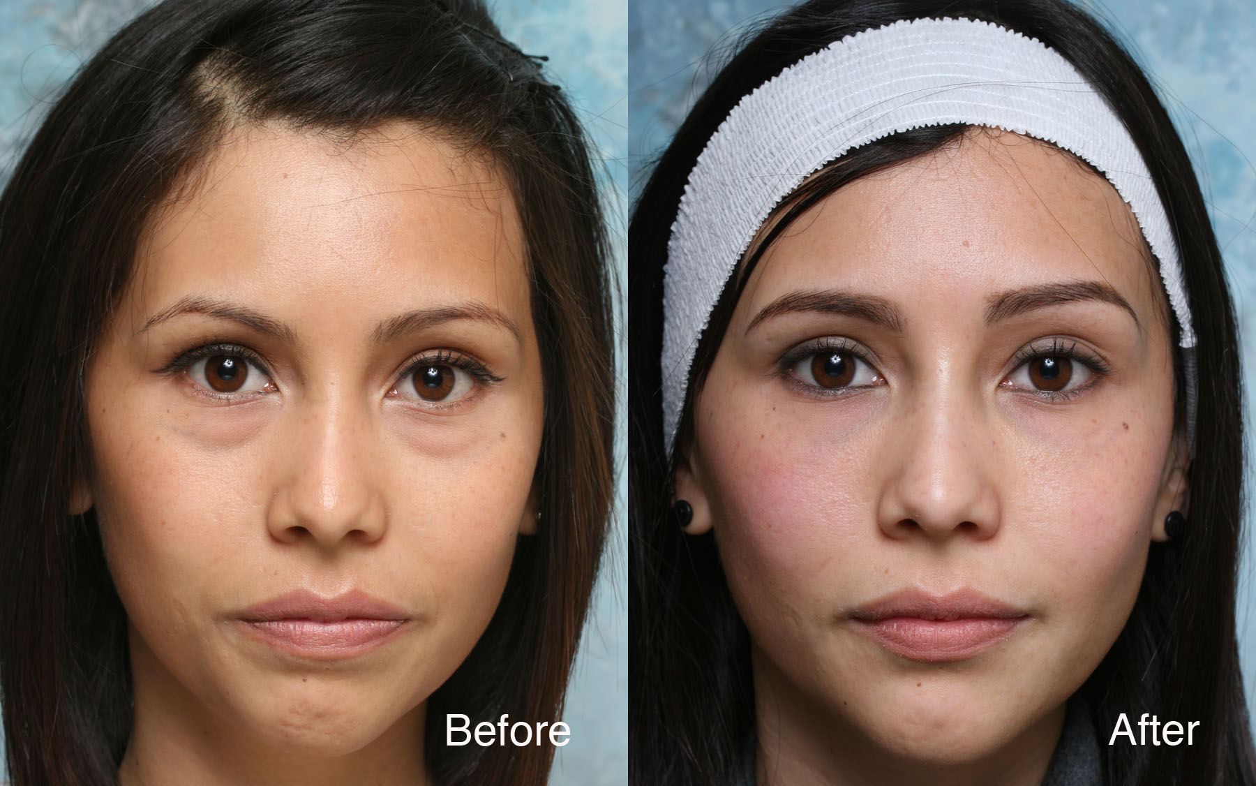 dark circles treatment Beverly Hills