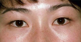 Asian eyelid surgery Beverly Hills