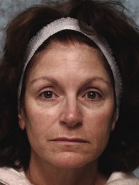 chemical peel beverly hills before