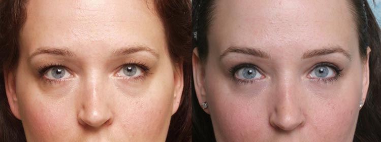 Upper eyelid surgery before and after