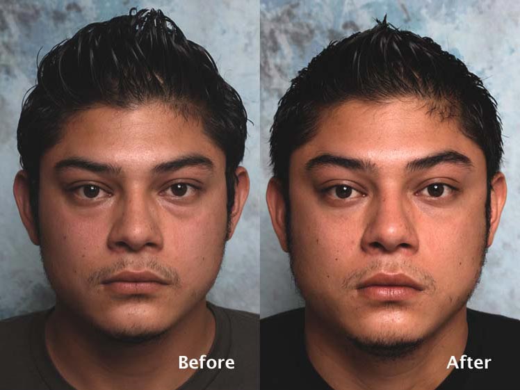 Blepharoplasty for Men