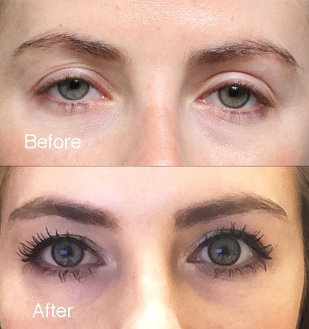 Fixing Botched Upper Eyelid beverly hills