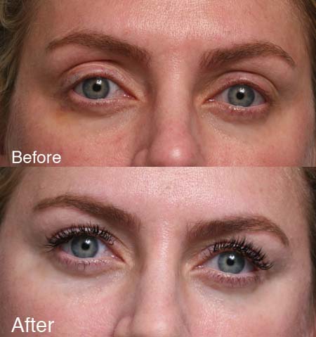 Fixing Botched Upper Eyelid beverly hills