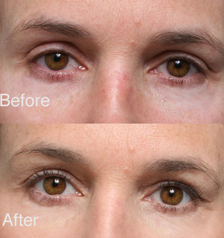 Fixing Botched Upper Eyelid beverly hills