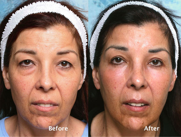 Lower Eyelid Surgery