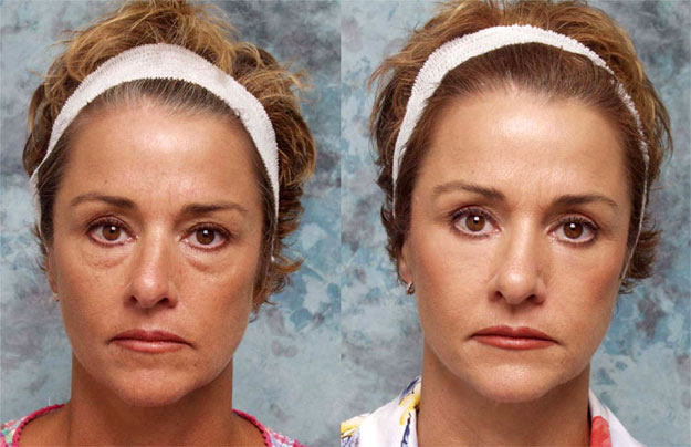 Lower Eyelid Surgery