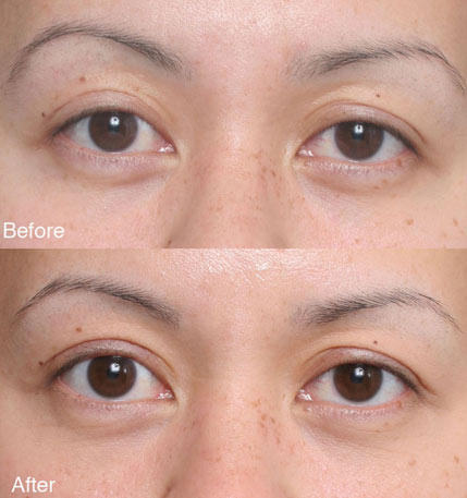 ptosis Beverly Hills patient 4