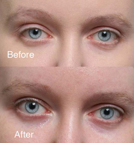 ptosis Beverly Hills patient 5