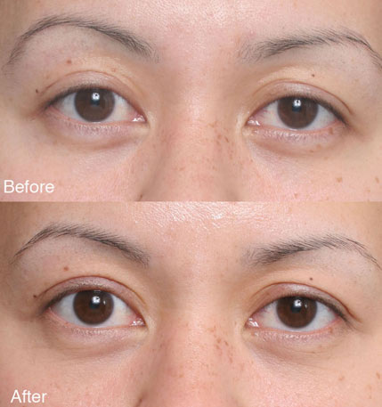 ptosis Beverly Hills patient 6