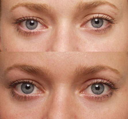 Upper eyelid surgery