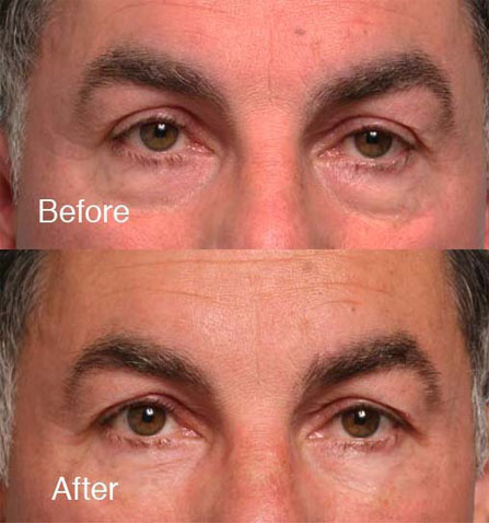 Upper eyelid surgery