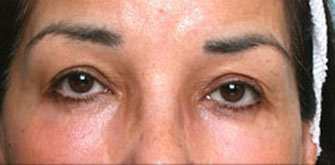 After Lower Eyelid Surgery Bevelry Hills Dr. Steinsapir