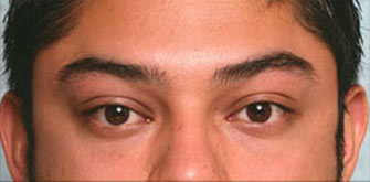 After Lower Blepharoplasty Los Angeles Dr. Steinsapir