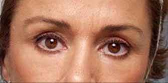 After Lower Blepharoplasty Beverly Hills Dr. Steinsapir